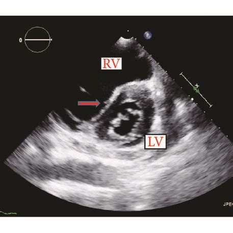 d shaped left ventricle diagram.